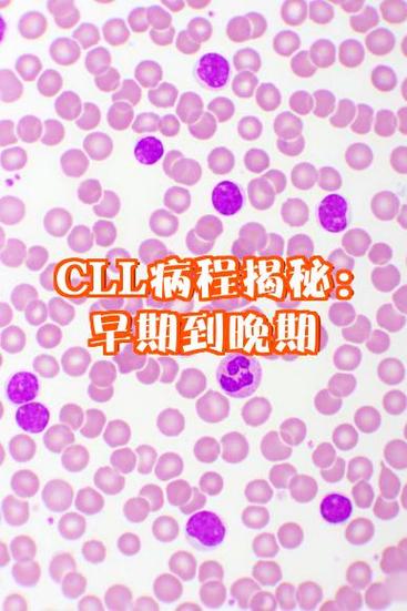 白血病早期低热的规律
