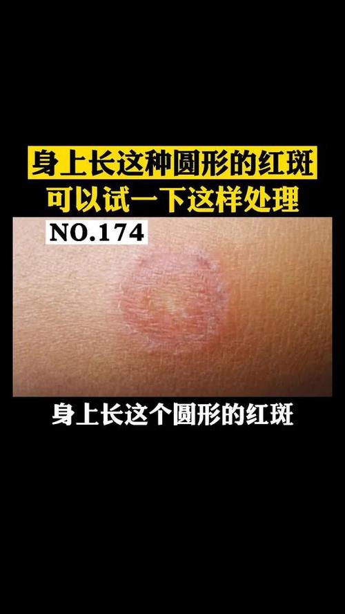 皮肤出现一个环状红圈