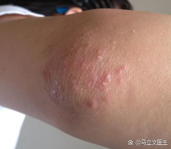手胳膊痒起小疙瘩是什么原因