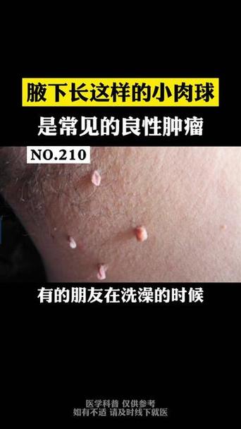腋下长小肉揪是怎么回事
