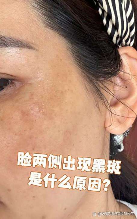 脸上有黑斑是怎么回事
