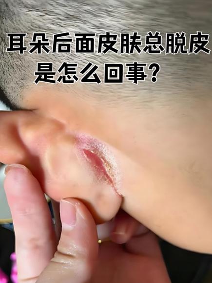 耳朵裂开了一条缝是什么原因