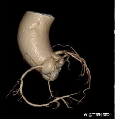 脚感觉有蚂蚁爬是怎么回事
