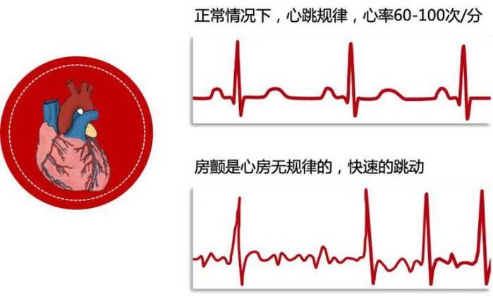 心脏跳动不规律是什么病