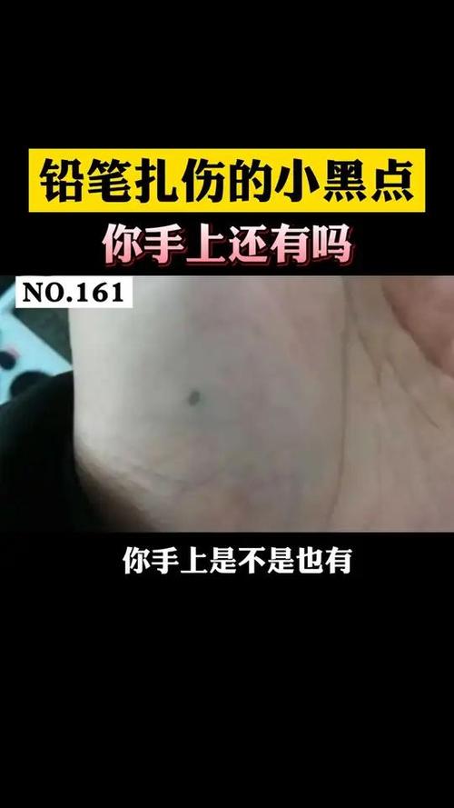 黑笔戳破皮肤留下黑点缩略图