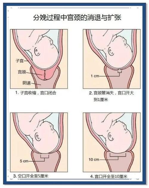 加快顺产开宫口的方法