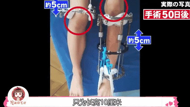 身高可以做手术长高吗