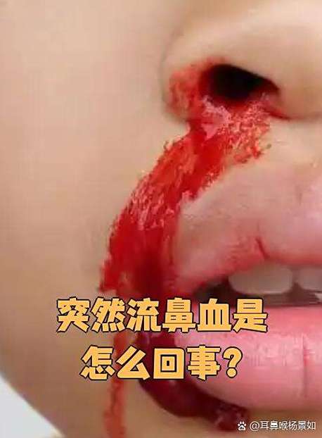 订婚当天流鼻血怎么回事