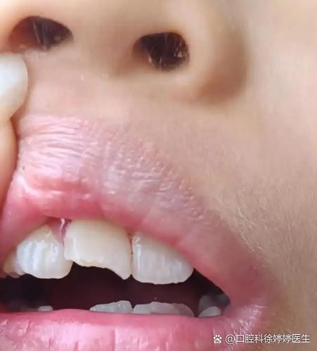 摔到牙齿磕掉了一小块