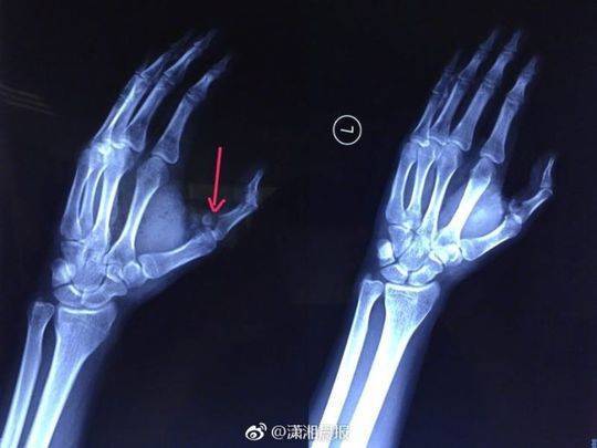 手指里有断针会走动吗截图