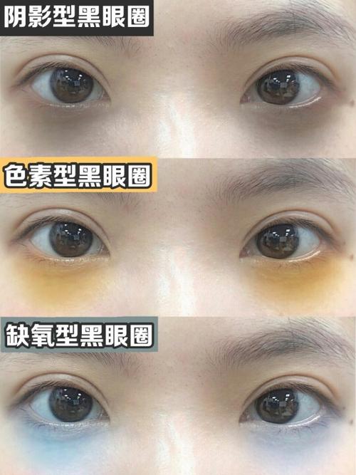 怎么去黑眼圈