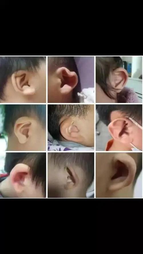 婴儿耳朵为什么会畸形