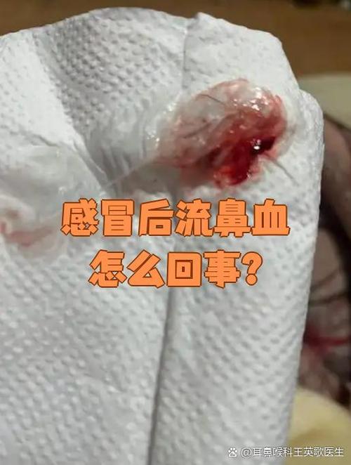 鼻子不通流黄鼻涕还流鼻血