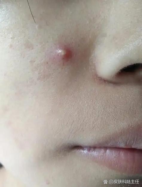 痘痘挤完之后鼓起个包硬硬的