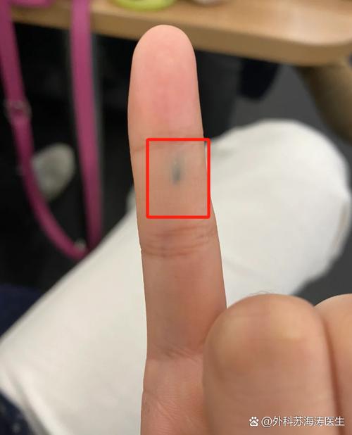 铅笔扎进肉里黑印处理截图
