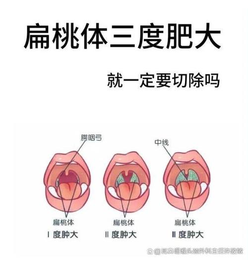 为什么会扁桃体肥大
