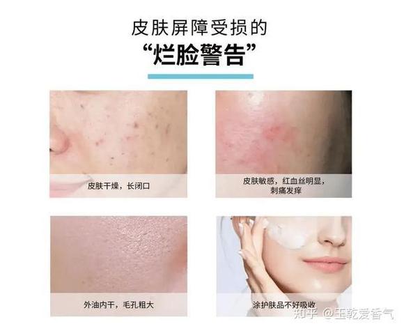 脸部补水刺痛什么原因