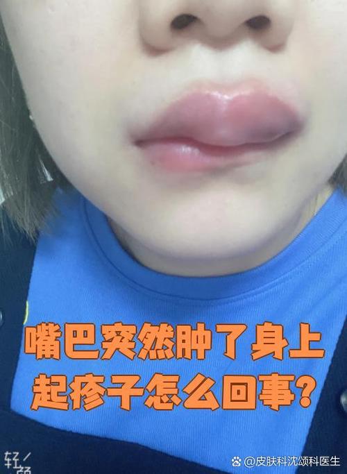 荨麻疹会引起嘴巴肿吗