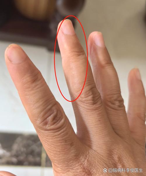 手指突然抽搐