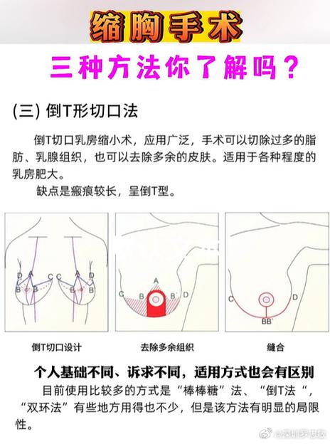 缩胸手术的全过程