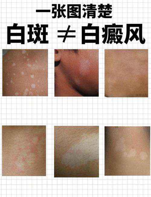 皮肤白斑和白点癫区别图片