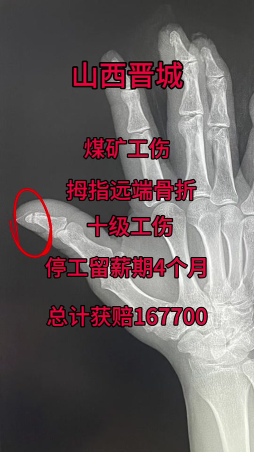 大姆脚趾骨折几级工伤图标