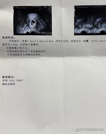 孕七周囊性暗区正常图标