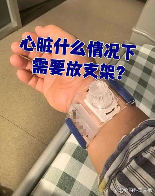 心脏放一个支架严重吗缩略图