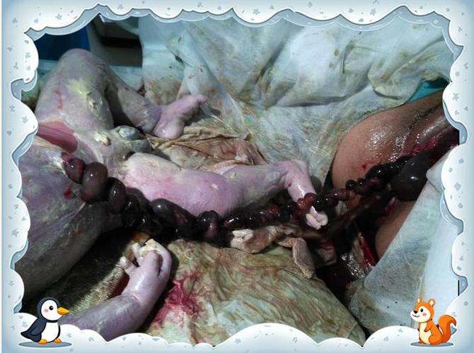 妊振2死胎隔绝