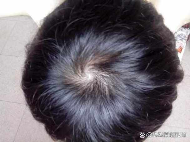 头旋形成的原因图标