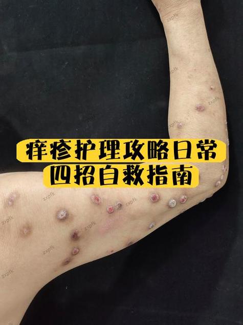 脚上痒一挠就起小水泡