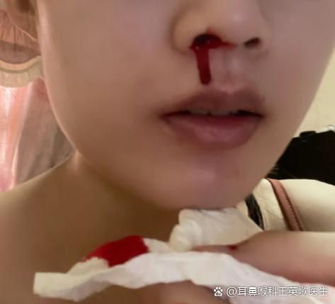 喝酒流鼻血危险吗