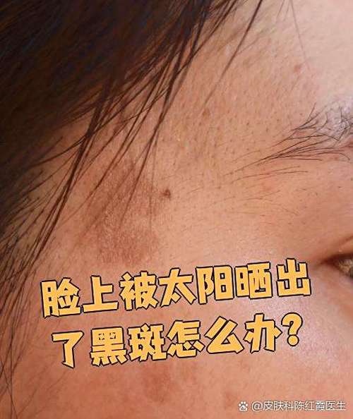 脸上晒的黑斑怎么去掉