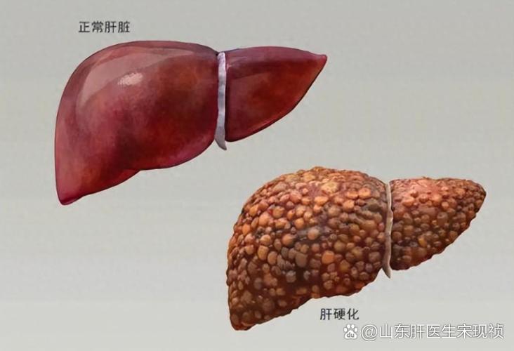乙肝是很严重的病吗图标
