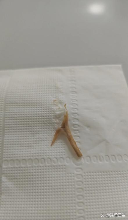 鸡骨卡住了5天喉镜也找不到