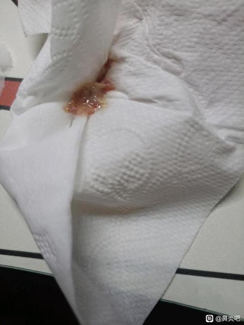 每天擤鼻涕都有血是怎么回事