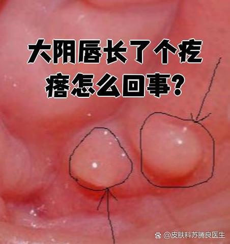 女性下面长出来一个疙瘩是怎么回事