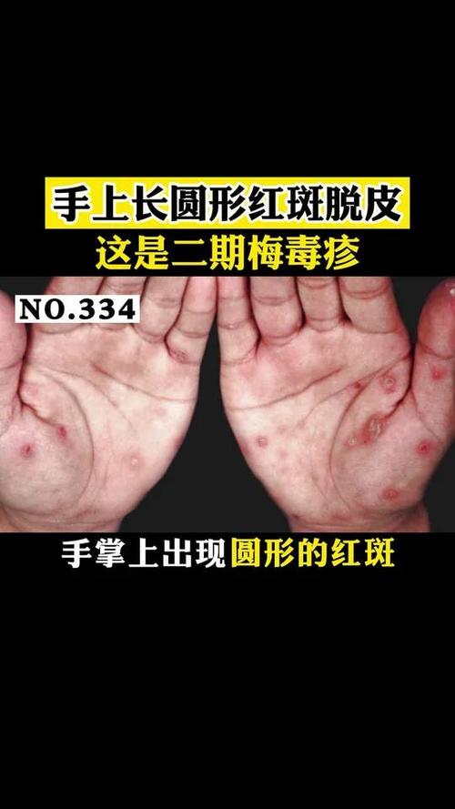 手上皮肤出现红圆圈