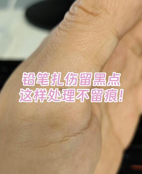 黑斑点怎么去掉