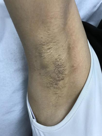 腋窝痒越抓越痒有小疙瘩