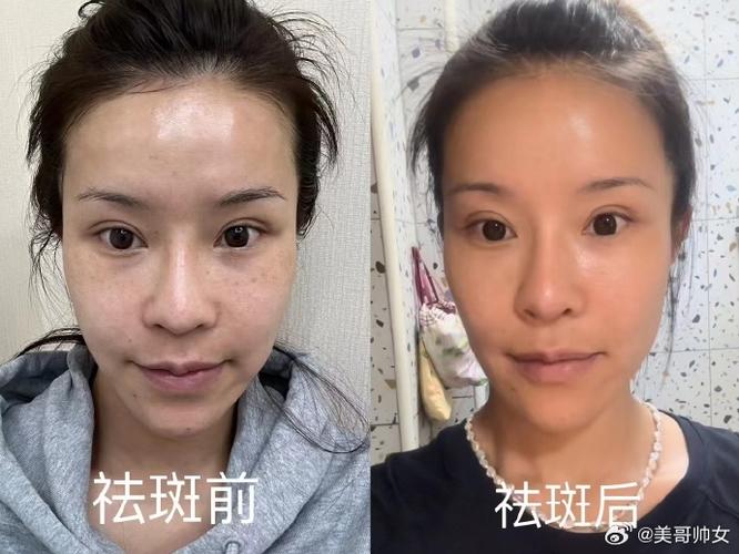 先祛斑还是先打水光