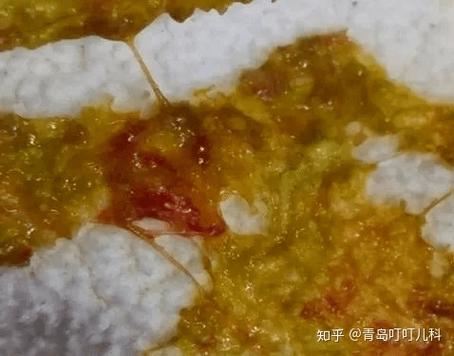大便带果冻状粘液
