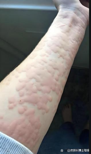 荨麻疹的照片