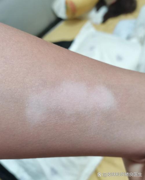 老年白斑病是一种什么病