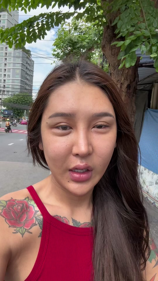 脂肪填充五年后遗症