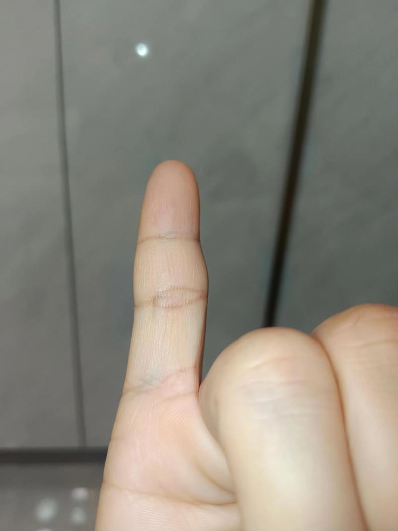 小拇指戳了一下伸不直