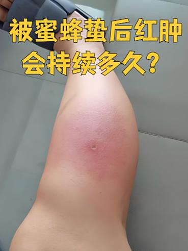 蜜蜂蜇了需要去医院吗