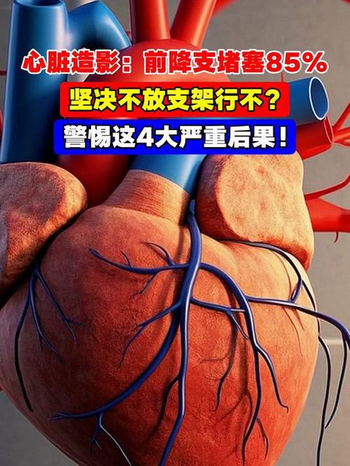 心脏堵了80不支架行吗
