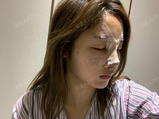 库欣病术后几天出院