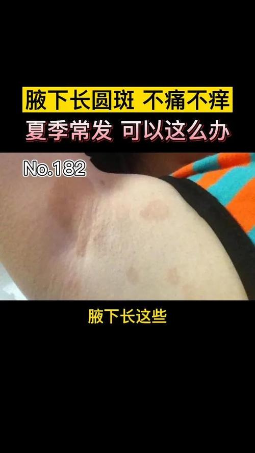 腋下长了褐色的斑块是什么原因
